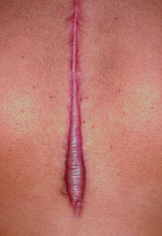 6 Types of Hypertrophic Scar Treatment | DermeffaceFX7 Info