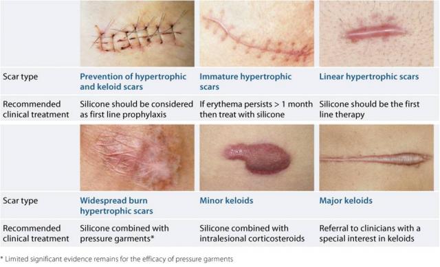 Scar Treatment Pressure Garments